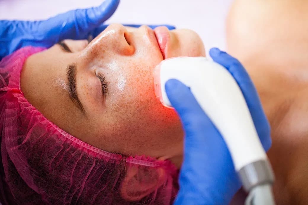 What Is Laser Skin Resurfacing?