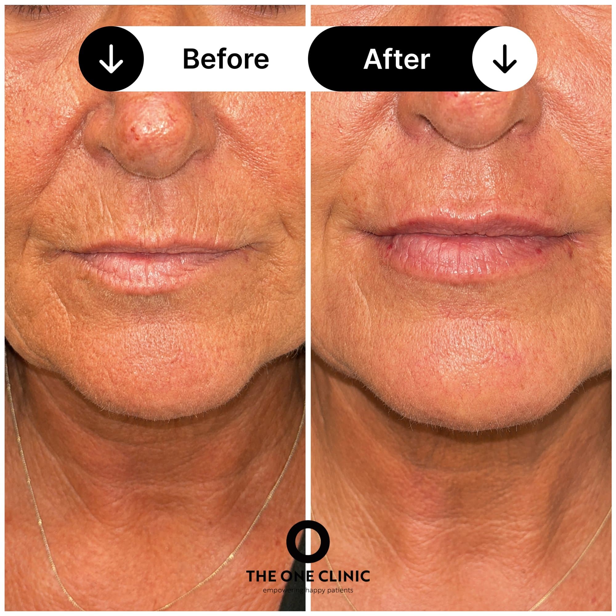 Anti-wrinkle injections before and after results