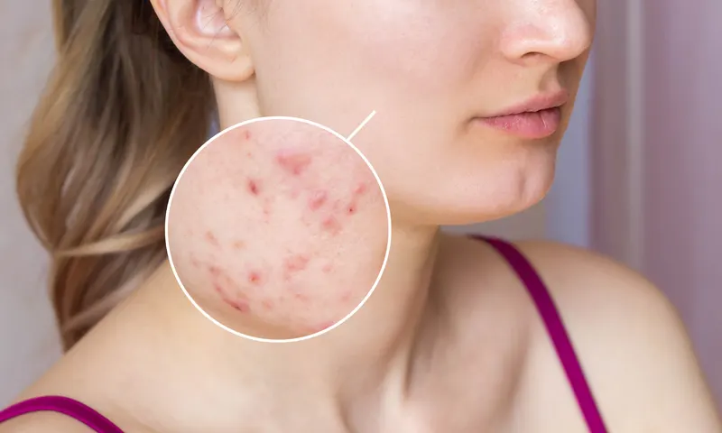 Close-up of acne marks and scars on a woman’s cheek