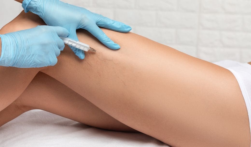 Thread Vein Removal Leicester